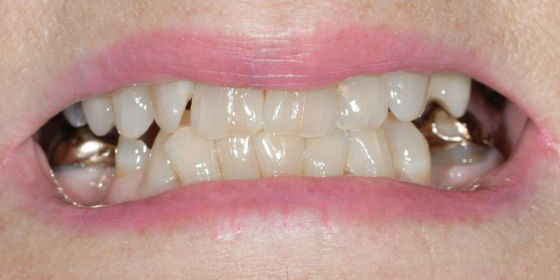 Close-up of a person's mouth showing worn, discolored teeth with dental restorations visible on molars.