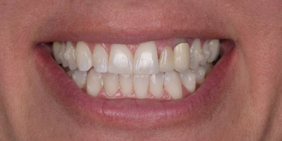Close-up of a smile showing teeth with some discoloration and uneven coloring.