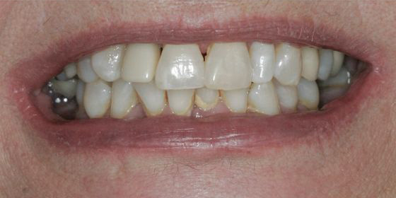Close-up of a person's teeth showing slight discoloration and uneven spacing.