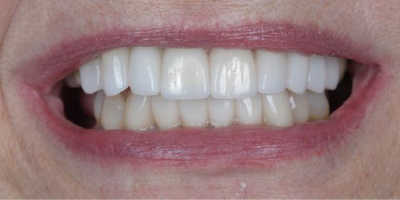 Close-up of a person’s mouth showing upper teeth with dental veneers and natural lower teeth.