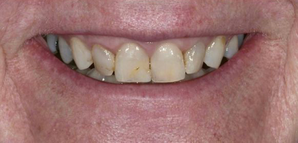 Close-up of a person's smile showing stained and misaligned upper front teeth with visible plaque.
