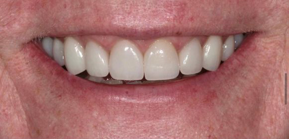 Close-up of a person's smile showing clean, white, evenly aligned upper front teeth.