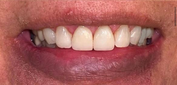Close-up of a person's closed smile showing upper front teeth and lips.