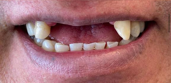 Close-up of a mouth with several missing and misaligned teeth, showing worn and uneven lower front teeth.