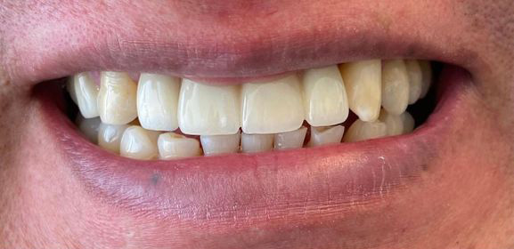 Close-up of a person's smile showing upper and lower teeth with slight discoloration and uneven alignment.