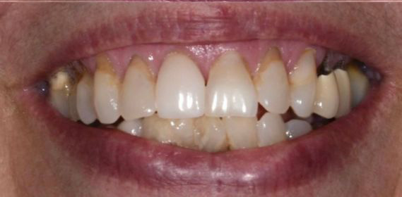 Close-up of a person's mouth showing teeth with discoloration and dental plaque.