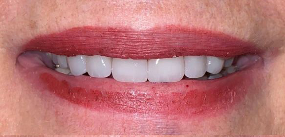 Close-up of a smile showing white teeth and lips with faded red lipstick.