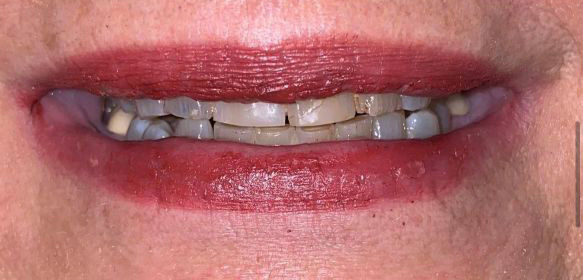 Close-up of a mouth with lips partially open revealing stained, chipped, and uneven teeth.
