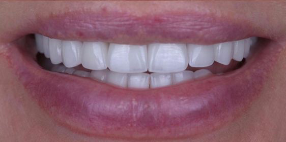 Close-up of a smile showing clean, evenly aligned white teeth and natural lips.