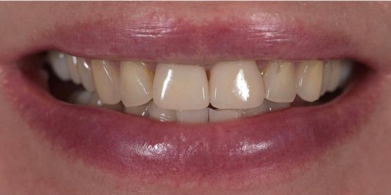 Close-up of a person's mouth showing slightly parted lips and visible upper and lower teeth.