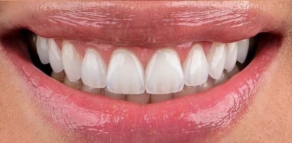 Close-up of a smiling mouth showing clean, white front teeth and glossy pink lips.
