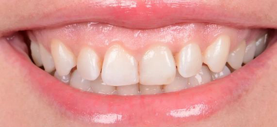 Close-up of a smile showing upper teeth with slightly uneven alignment and healthy gums.