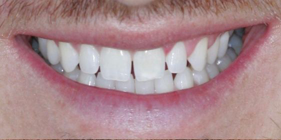 Close-up of a person’s smiling mouth showing upper and lower teeth with slight gaps and a faint mustache above the upper lip.