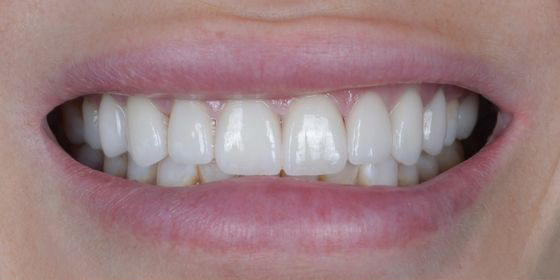 Close-up of a person's mouth smiling, showing clean and well-aligned upper and lower teeth.