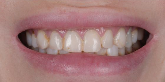 Close-up of a smile showing teeth with visible plaque and discoloration.