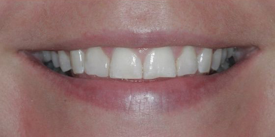 Close-up of a person's smile showing upper front teeth with slight discoloration and uneven edges.