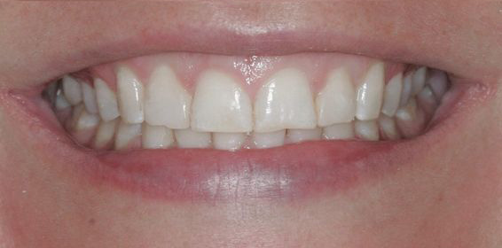Close-up of a person's smile showing slightly uneven upper teeth with a small gap between the front two teeth.