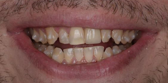 Close-up of a person’s mouth showing misaligned, yellowed teeth with gaps and uneven edges.