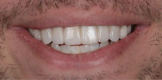Close-up of a smiling mouth showing clean, white teeth and some facial hair around the lips.