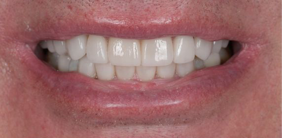 Close-up of a smile showing clean, white upper and lower teeth with veneers.
