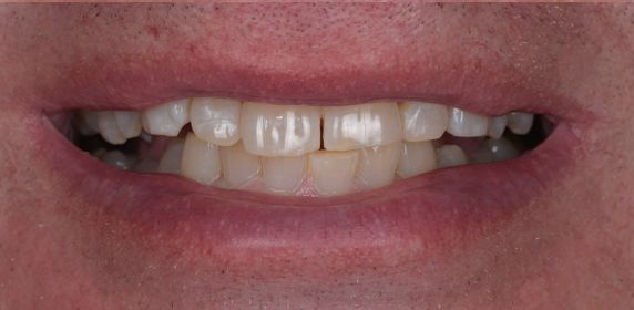 Close-up of a person's mouth showing teeth with gaps and slight discoloration.