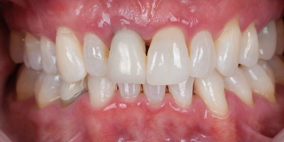 Close-up of a person's mouth showing misaligned and uneven upper front teeth with a visible gap.