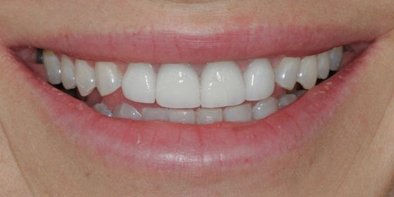 Close-up of a smile showing slightly uneven and discolored upper front teeth.