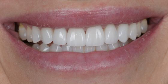 Close-up of a smiling mouth showing white, even teeth with dental veneers.