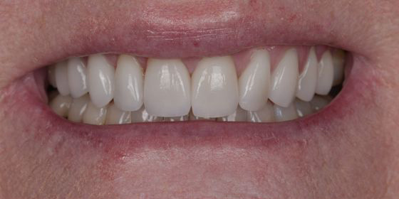 Close-up of a smiling mouth showing straight, white teeth with dental veneers.