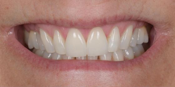Close-up of a smile showing upper front teeth with dental veneers blending with natural teeth.