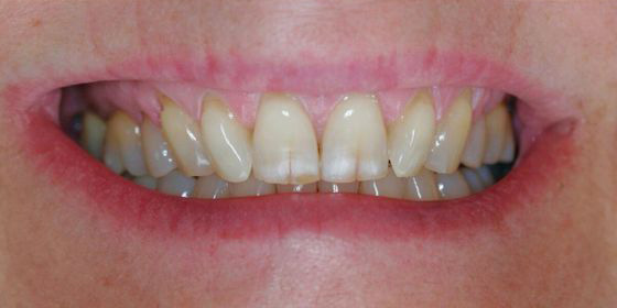 Close-up of a person's smile showing teeth with discoloration and gaps.