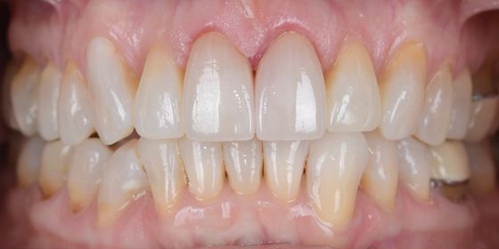 Close-up of human teeth showing dental veneers on front teeth.