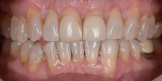 Close-up of teeth showing uneven coloration and wear, with some visible plaque and staining near the gums.