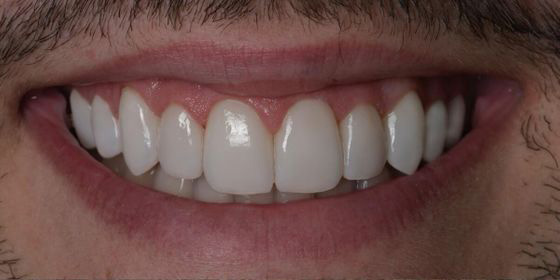 Close-up of a smiling mouth showing clean, white teeth with dental veneers.