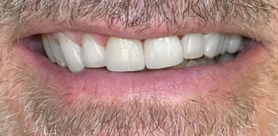 Close-up of a person's mouth showing upper front teeth and facial hair around the lips.