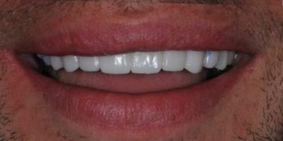 Close-up of a smile showing white upper teeth and lips with light facial hair.