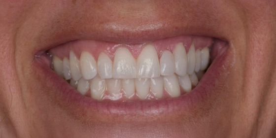 Close-up of a person smiling showing healthy, clean upper and lower teeth.