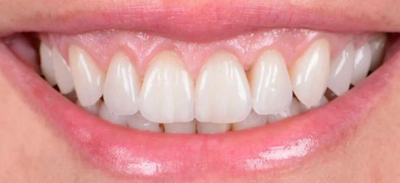 Close-up of a smiling mouth showing clean, straight upper and lower teeth.