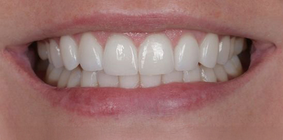 Close-up of a person's smile showing clean, white teeth and pink lips.