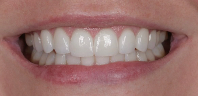 Close-up of a person smiling showing clean, white teeth and pink lips.