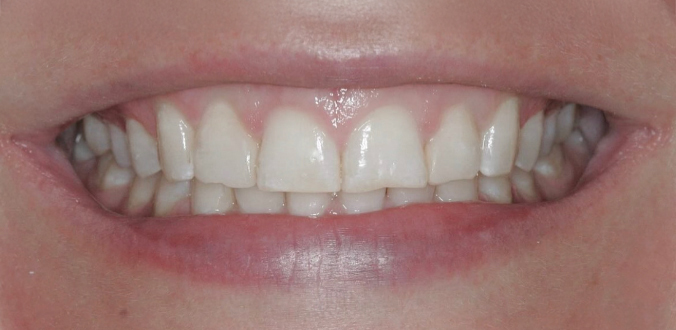 Close-up of a person's mouth showing a smile with slightly uneven upper front teeth.