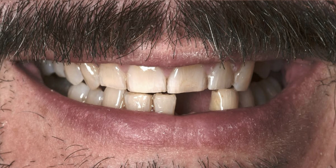 Close-up of a man's mouth with a mustache showing uneven, chipped, and discolored teeth with a missing front tooth.