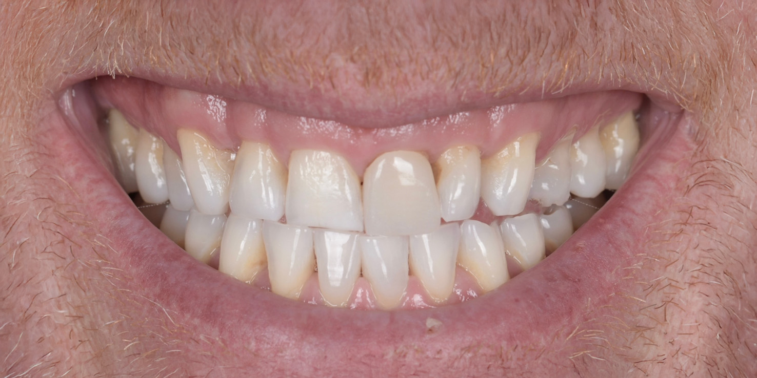 Close-up of a smiling mouth showing teeth with slight discoloration and natural texture on lips and facial hair.