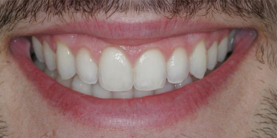 Close-up of a smiling mouth showing clean, straight, and white teeth with healthy gums.