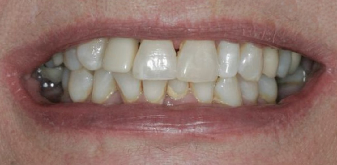 Close-up of a person's mouth showing upper and lower teeth with visible plaque and discoloration.