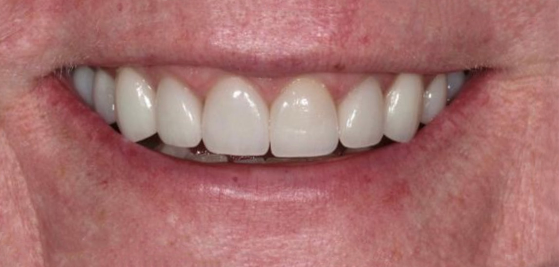 Close-up of a smiling mouth showing clean, well-aligned upper teeth with light skin around the lips.