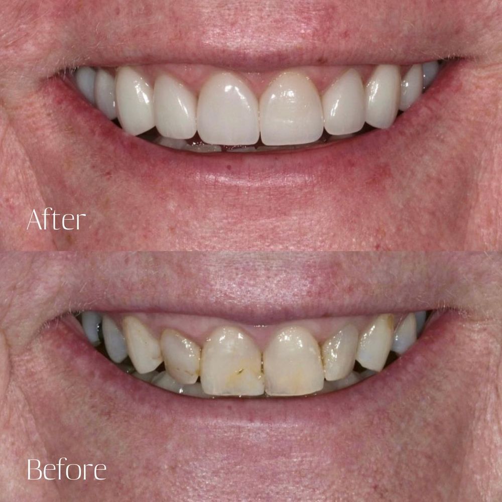 Before and after mouth rehabilitation