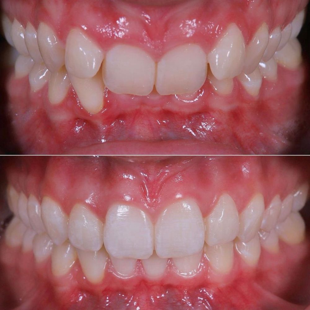 Before and after invisalign