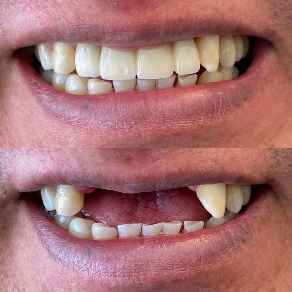 before and after dental implant