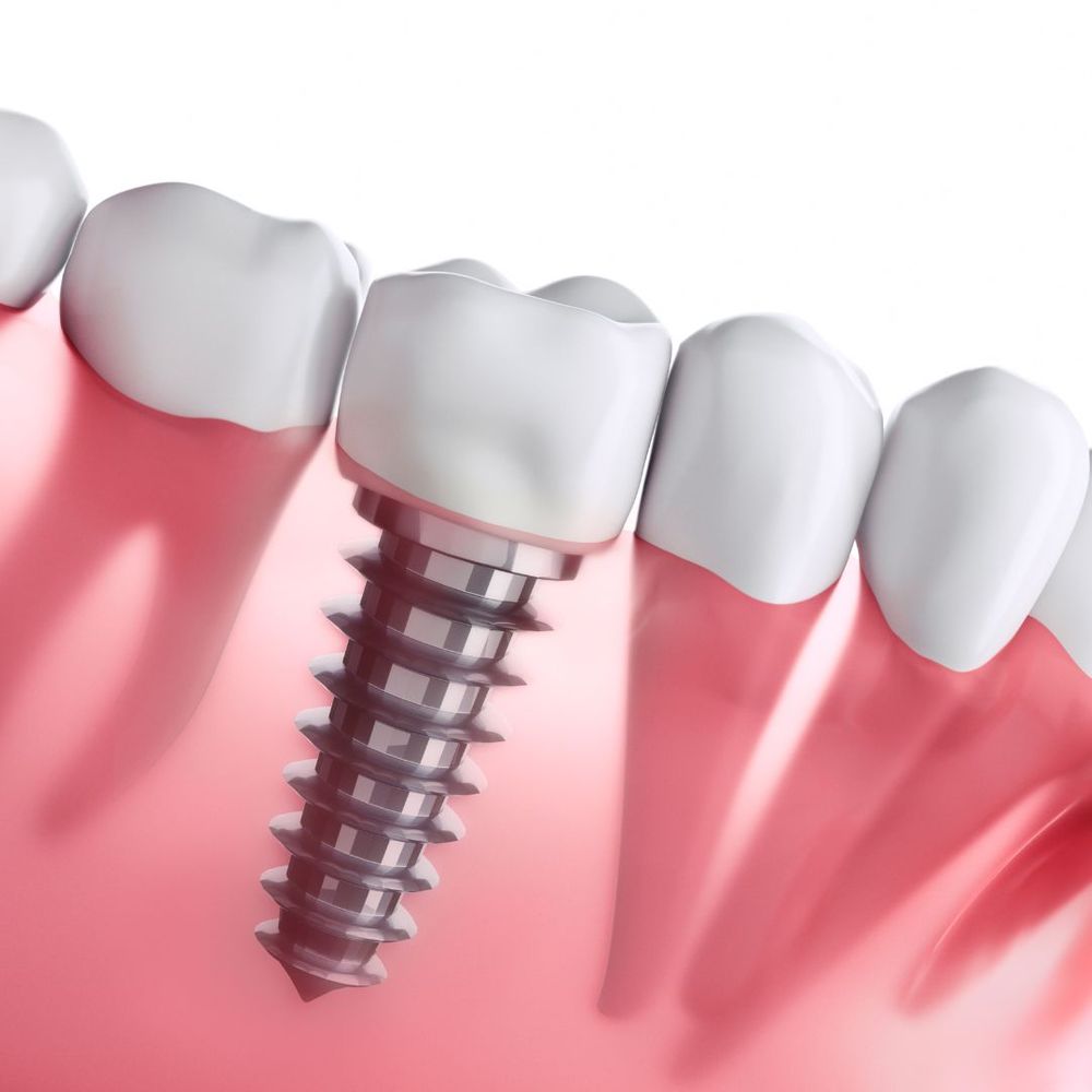 dental implant